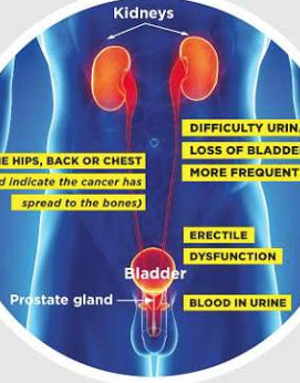 A personal journey through prostate cancer, which needs as much a spotlight as breast cancer in women