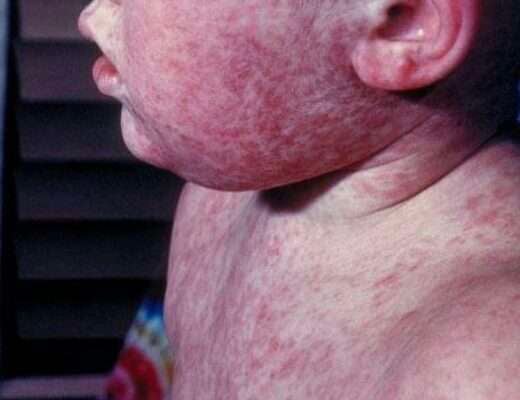 Kentucky health officials report four new measles cases; immunizations prevent spread